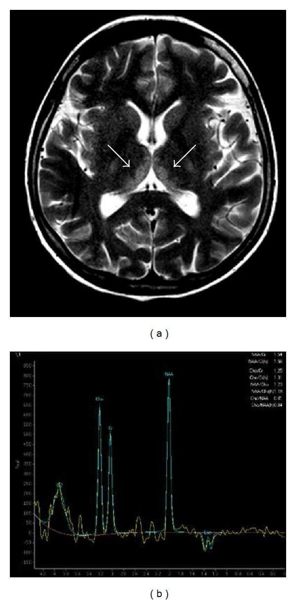 This composite diagnostic image features a T2-weighted axial MRI and an MR spectroscopy (MRS) plot, illustrating the classic neuroimaging findings of Wernicke’s encephalopathy in a patient with chronic alcohol abuse. Image (a) is an axial T2-weighted brain MRI demonstrating bilateral, symmetric hyperintense signal abnormalities within the medial thalami (indicated by arrows), representing vasogenic or cytotoxic edema typical of thiamine deficiency. Image (b) shows a single-voxel MR spectroscopy (MRS) profile acquired from the affected thalamic region. The spectrum exhibits biochemical markers of neuronal injury, specifically a reduced N-acetylaspartate (NAA) peak relative to Creatine (Cr) and Choline (Cho), indicating neuronal loss or dysfunction. Additionally, a notable lactate (Lac) peak, seen as an inverted doublet at 1.3 ppm, suggests a shift to anaerobic metabolism and localized lactic acidosis. This combination of structural MRI and metabolite quantification serves as a critical diagnostic tool for identifying metabolic encephalopathies and assessing the extent of reversible versus irreversible brain damage.