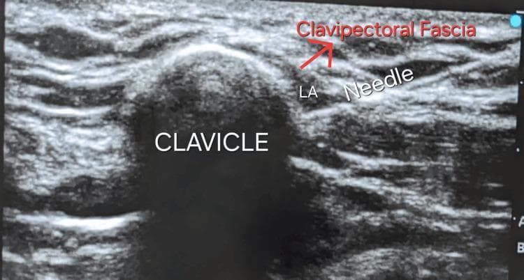 This diagnostic ultrasound image demonstrates the performance of a clavipectoral fascial plane block for regional anesthesia. The central landmark is the clavicle, identified as a hyperechoic, semi-circular cortical surface with a prominent posterior acoustic shadow. Superficial to the bone, the clavipectoral fascia appears as a distinct layer of organized, hyperechoic linear bands. A hyperechoic needle is visualized using an in-plane approach, with its tip positioned within the fascial plane. An anechoic space labeled 'LA' indicates the administration of local anesthetic, which is seen separating the fascial layers. This imaging illustrates the precise needle-to-target relationship required for effective anesthesia in the management of clavicular fractures. The anatomical context focuses on the pectoral region, utilizing the high-frequency linear probe to distinguish soft tissue layers from bony landmarks.