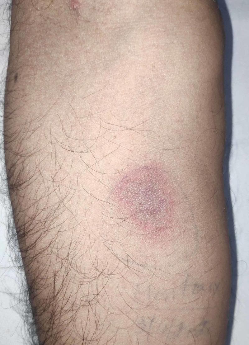 This clinical photograph displays a Mantoux tuberculin skin test site on the volar aspect of a human forearm, 72 hours post-intradermal injection of purified protein derivative (PPD). The visual findings demonstrate a positive reaction characterized by a central, well-defined zone of induration exhibiting a reddish-purple, dusky hue. Surrounding the induration is a peripheral ring of lighter pink erythema. The lesion is roughly circular in morphology, measuring approximately 24 mm in diameter. The surrounding skin appears otherwise normal with standard follicular distribution. This image is a classic educational representation used in infectious disease and pulmonology to illustrate delayed-type hypersensitivity (Type IV) reactions and screening for Mycobacterium tuberculosis infection. Key diagnostic features highlighted include the palpable firmness (induration) and the significant size threshold indicating a positive result in clinical diagnostic protocols.