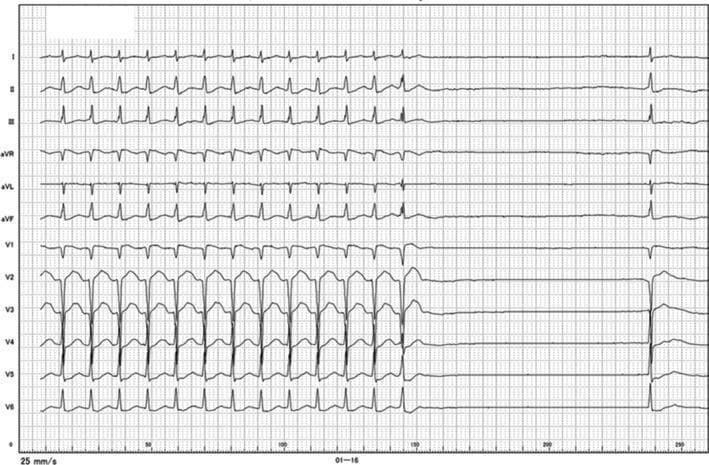 This diagnostic image is a 12-lead electrocardiogram (ECG) demonstrating a tachycardia-bradycardia event. The tracing begins with an incessant, regular, narrow QRS complex tachycardia at a rate of approximately 140-150 beats/min. No clear P-waves are visible preceding the QRS complexes, which is consistent with the patient's history of persistent atrial fibrillation. Following the rapid rhythm, there is a sudden spontaneous termination leading to a significant ventricular pause (asystolic period) lasting approximately 3.7 seconds before a single escape beat occurs. The morphology of the QRS during the tachycardia is narrow, suggesting a supraventricular origin or an atrioventricular junctional rhythm. This ECG is a classic representation of tachycardia-induced suppression of the conduction system, often seen in the context of sick sinus syndrome or advanced atrioventricular conduction disturbances associated with long-standing atrial fibrillation. It illustrates the clinical phenomenon where a rapid rhythm is followed by prolonged electrical silence, potentially leading to symptoms of palpitations and syncope.