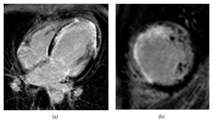 This diagnostic image displays two cardiac magnetic resonance imaging (MRI) views obtained using Late Gadolinium Enhancement (LGE) technique to assess myocardial viability. Panel (a) is a four-chamber view showing subendocardial delayed enhancement in the anterolateral segment, involving less than 50% of the myocardial thickness, indicative of non-transmural infarction. Panel (b) is a short-axis view demonstrating transmural delayed enhancement of the midcavitary septal segment, where high signal intensity extends across the entire wall thickness. The imaging findings are consistent with myocardial infarction in the left anterior descending (LAD) artery territory. These views are essential for distinguishing between viable and non-viable myocardium in the setting of coronary artery disease or vasospasm-induced ischemia, as seen in this clinical case involving khat-induced vasospasm.
