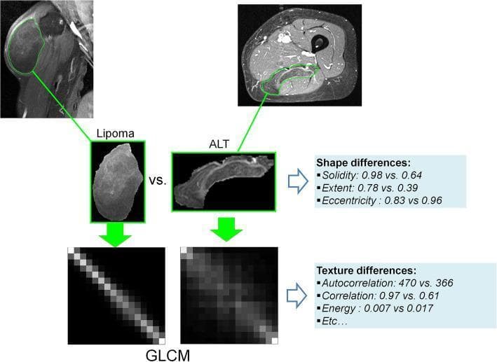 This infographic demonstrates the radiomics pipeline for differentiating benign lipomas from malignant Atypical Lipomatous Tumors (ALT) using MRI. The image includes fat-suppressed enhanced MR images of the shoulder and thigh, showing green binary tumor masks applied to representative lesions. A side-by-side comparison highlights morphology: the lipoma is presented as a well-defined, ovoid mass, while the ALT is depicted as an irregular, elongated structure. These visual markers are supported by quantitative shape radiomics, including solidity (0.98 vs. 0.64), extent (0.78 vs. 0.39), and eccentricity (0.83 vs. 0.96). The lower section of the diagram illustrates texture analysis via the Gray-Level Co-occurrence Matrix (GLCM). The lipoma GLCM displays a highly organized, linear diagonal pattern, whereas the ALT GLCM shows a dispersed, heterogeneous distribution. Quantitative texture metrics include autocorrelation (470 vs. 366), correlation (0.97 vs. 0.61), and energy (0.007 vs. 0.017). This visualization emphasizes how radiomic features can objectively characterize soft tissue tumors in musculoskeletal radiology.