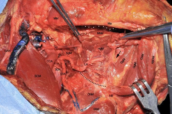 A clinical photograph of a cadaveric dissection illustrating the surgical anatomy of the submandibular and submental regions during a compartmental surgery of the tongue. The image demonstrates the intricate relationships between extrinsic tongue muscles, vascular structures, and nerves. Key anatomical landmarks include the mandible (Ma), hyoid bone (HB), and the mylohyoid (MhM), hyoglossus (HgM), genioglossus (GgM), and geniohyoid (GhM) muscles. Vascular structures shown include the common carotid artery (CCA) branching into the superior thyroid artery (STA) and the lingual artery (LA), the latter of which is seen coursing deep to the hyoglossus muscle. The hypoglossal nerve (XII) and superior laryngeal nerve (SLN) are clearly identified. Superficially, the sternocleidomastoid muscle (SCM), external jugular vein (EJV), and great auricular nerve (GAN) are visible. Dotted lines delineate the mylohyoid line of the mandible and the great hyoid cornu, while a black arrow points to the paramedian septum of the tongue, providing critical orientation for oncological resection pathways.
