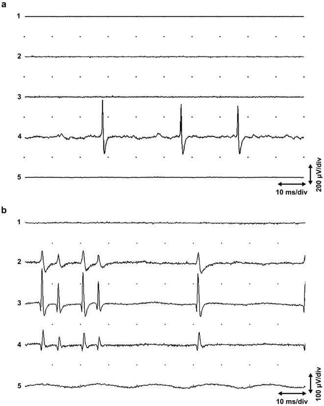This diagnostic image displays two sets of five-channel needle electromyography (EMG) recordings (a and b) from the human extensor carpi radialis muscle. The electrodes were placed 2 mm apart in parallel within a single muscle fasciculus to study spontaneous neuromuscular junction activity.
Panel (a) illustrates local end plate activity. Channel 4 shows non-propagating 'end plate spikes' characterized by high-frequency biphasic waveforms superimposed on low-amplitude, irregular 'end plate noise.' Channels 1, 2, 3, and 5 remain quiescent, indicating the highly localized nature of these potentials.
Panel (b) demonstrates propagating end plate spikes. Unlike the local activity in (a), the potentials here are visible across channels 2, 3, and 4. These spikes show variations in amplitude and morphology, reflecting the spatial propagation of action potentials for a short distance along the muscle fiber.
Calibrations are provided as 10 ms/div horizontally, with vertical sensitivity at 200 µV/div for (a) and 100 µV/div for (b). This comparison is educationally significant for distinguishing between stationary end plate noise and propagated intrafusal or extrafusal potentials in clinical neurophysiology.