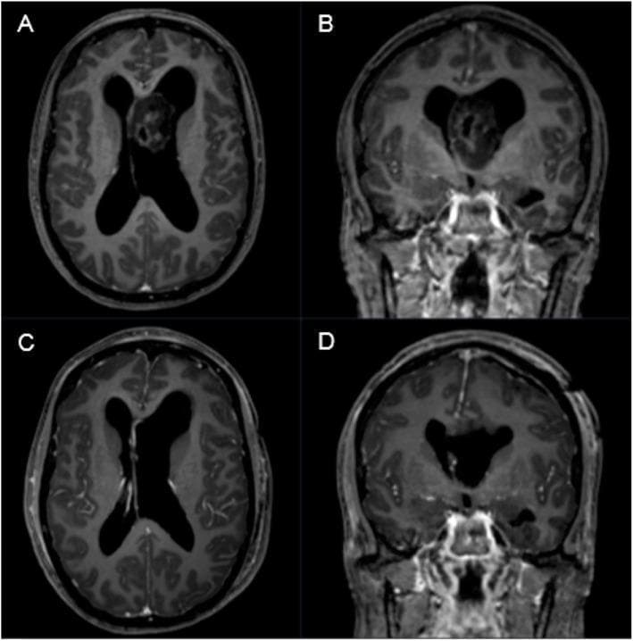 This diagnostic imaging panel consists of four T1-weighted gadolinium-enhanced MRI scans (axial and coronal views) demonstrating a case of a third ventricle tumor and its postoperative outcome. Figures A (axial) and B (coronal) show a preoperative heterogeneously enhancing, low-to-intermediate signal intensity mass within the third ventricle. This intraventricular lesion causes significant obstructive hydrocephalus, evidenced by the marked enlargement of the lateral ventricles. Figures C (axial) and D (coronal) display postoperative results following a left frontal transventricular keyhole resection. These images confirm gross total removal of the tumor, resolution of the third ventricle occupancy, and a subsequent reduction in the size of the ventricular system, indicating improved cerebrospinal fluid flow. The case is pathologically identified as a WHO grade I subependymoma. This educational sequence illustrates the radiological presentation of a rare benign neuroepithelial tumor and the effectiveness of surgical intervention in managing secondary hydrocephalus.