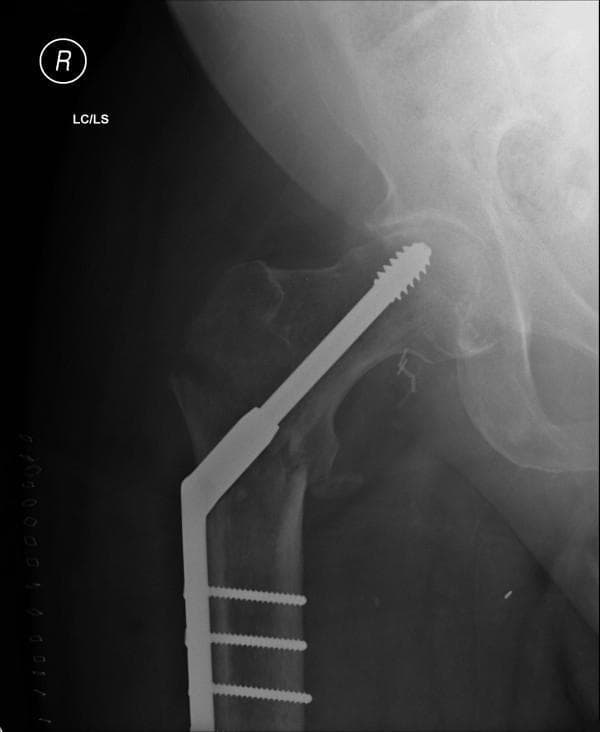 This diagnostic image is an anteroposterior (AP) plain radiograph of the right hip and proximal femur, demonstrating postoperative internal fixation of an intertrochanteric fracture. The primary orthopedic implant is a Dynamic Hip Screw (DHS) system. It features a large-diameter lag screw with a serrated distal tip centrally positioned within the femoral head to provide compression across the fracture site. This lag screw is coupled with a side plate that is securely fixed to the lateral cortex of the femoral shaft using three transverse cortical screws. The design of the DHS allows for controlled collapse and impaction along the axis of the lag screw during the weight-bearing and healing process. Radiographically, the femur exhibits features suggestive of osteopenia, characterized by reduced bone density and thinning of the cortical margins. The image captures the relationship between the femoral head, the greater and lesser trochanters, and the pelvic acetabulum, providing a clear demonstration of surgical management for geriatric hip trauma in an orthopedic clinical context.