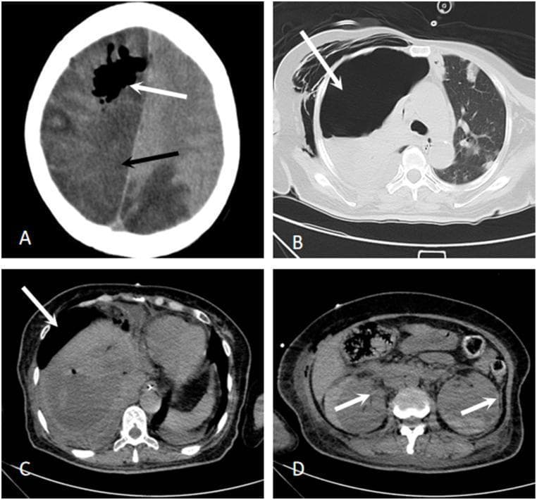 A series of four axial CT images (A–D) demonstrating multi-organ complications in a clinical case. Image A (Brain CT): Shows extensive regions of low density across the right hemisphere and left posterior lobes, consistent with massive infarction. Intraparenchymal gas pockets (white arrow) and a significant midline shift to the left indicate pneumocephalus and cerebral herniation. Image B (Chest CT): Displays a large right-sided pneumothorax (white arrow) with underlying lung atelectasis and consolidation, accompanied by subcutaneous emphysema in the soft tissues of the chest wall. Image C (Abdominal CT): Reveals a large hepatic lesion with an air-fluid level and a visible drainage tube (white arrow), characteristic of a liver abscess under treatment. Image D (Abdominal CT): Shows the bilateral kidneys with internal areas of altered density and scattered gas (white arrows), suggesting emphysematous or hemorrhagic foci. This sequence illustrates a severe systemic infectious process, such as invasive Klebsiella pneumoniae syndrome, leading to metastatic infections and emphysematous changes in multiple organ systems.