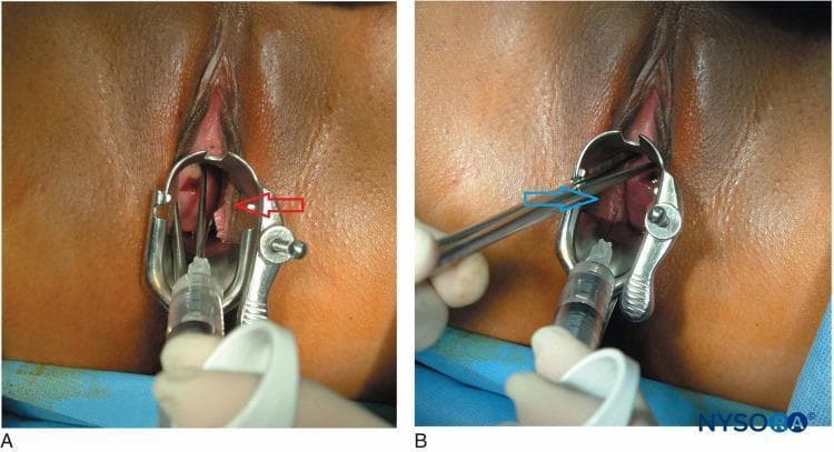 Two-panel clinical photograph (A and B) demonstrating the administration of a paracervical block in a gynecological setting. The images show a metal Grave's or Pederson speculum inserted into the vaginal vault to visualize the cervix and vaginal fornices. Panel A shows the injection of local anesthetic on the patient's left side (indicated by a red arrow) at the 4 o'clock position relative to the cervix. Panel B shows the injection on the patient's right side (indicated by a blue arrow) at the 8 o'clock position. A long, fine-gauge needle attached to a syringe is visible, being guided by a gloved clinician to the paracervical tissues. This procedure targets the Frankenhäuser plexus (uterovaginal plexus) to provide regional anesthesia for minor intrauterine procedures such as dilation and curettage (D&C). The anatomical landmarks visible include the labia majora, labia minora, vaginal canal, and the portio vaginalis of the cervix.