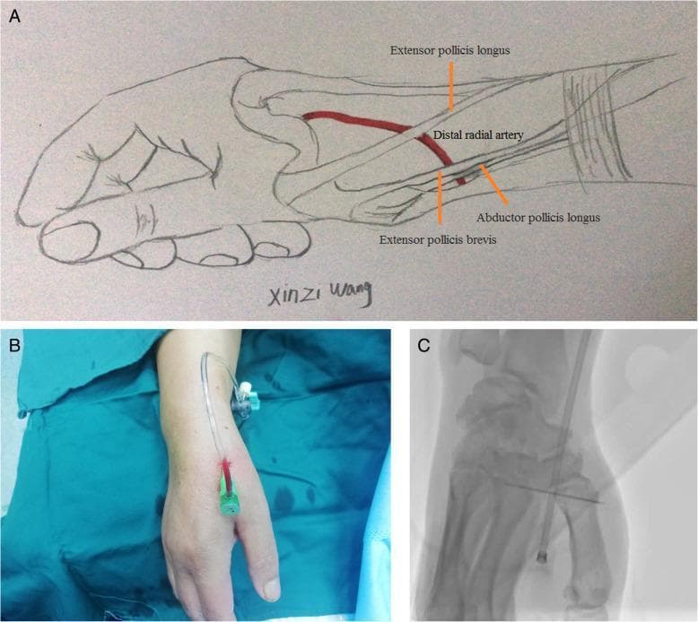 A multi-panel educational figure illustrating the anatomy and clinical application of distal radial artery (DRA) access. Panel A is an anatomical diagram of the hand and wrist highlighting the anatomical snuffbox. It depicts the distal radial artery in relation to key tendons: the extensor pollicis longus forms the medial border, while the abductor pollicis longus and extensor pollicis brevis form the lateral border. Panel B is a clinical photograph showing the procedural setup for distal transradial access (dTRA), featuring a 6Fr sheath successfully inserted into the snuffbox region with a connector tube attached. Panel C is a fluoroscopic diagnostic image (X-ray) providing a radiological view of the puncture site. It demonstrates the radiopaque sheath positioned within the DRA, localized near the radial styloid process and carpal bones. This figure is designed for medical professionals and interventionalists to understand the topographical and radiological landmarks necessary for arterial cannulation at the distal forearm/hand junction.