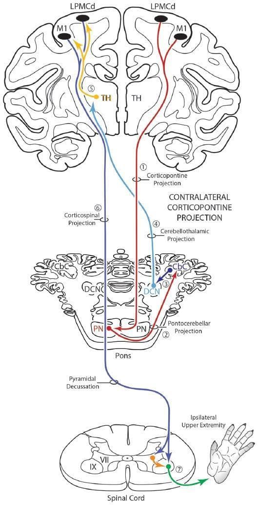 This medical schematic diagram illustrates the motor cerebrocerebellar system, highlighting both classical pathways and a modification involving the contralateral corticopontine projection (cCPP). The diagram is organized into four vertical levels: the cerebral cortex (top), thalamus (TH), pons and cerebellum (middle), and spinal cord with ipsilateral upper extremity (bottom).
Key anatomical structures labeled include the Primary Motor Cortex (M1), Dorsal Lateral Premotor Cortex (LPMCd), Thalamus (TH), Pontine Nuclei (PN), Deep Cerebellar Nuclei (DCN), Cerebellar Cortex (CbC), and Pyramidal Decussation.
Functional pathways depicted include:
1. Corticopontine Projection: Highlighting the cCPP (labeled 1, in red) originating from the motor cortex and crossing to the contralateral PN.
2. Pontocerebellar Projection (2): From the PN to the cerebellar cortex.
3. Cerebellothalamic Projection (4): From the DCN to the contralateral TH (blue line).
4. Corticospinal Projection (6): Descending from the cortex, crossing at the pyramidal decussation, and terminating in the spinal cord (purple line).
This diagram demonstrates how a bilateral corticopontine projection allows one hemisphere to theoretically influence both the contralateral and ipsilateral limbs through multisynaptic cerebellar circuits, aiding in complex motor coordination.