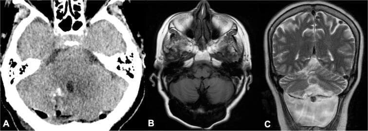 This composite figure displays postoperative and follow-up neuroimaging of a 66-year-old patient following surgical resection of neurocysticercosis. Panel (A) is an axial non-contrast head CT demonstrating the posterior fossa. Key features include the brainstem, cerebellum, and a centrally located fourth ventricle, with postoperative changes visible in the right cerebellar hemisphere indicating successful cyst removal. Panel (B) shows an axial T1-weighted brain MRI at the 2-year follow-up, confirming the absence of parasitic cyst recurrence. Panel (C) is a coronal T2-weighted brain MRI illustrating the posterior fossa anatomy and supratentorial brain parenchyma. This sequence highlights the cerebrospinal fluid (CSF) spaces, including the lateral and fourth ventricles. A hyperintense signal area at the pontomedullary junction suggests a CSF fistula, a known postoperative complication. The images collectively demonstrate the radiological assessment of treatment success for neurocysticercosis and the identification of long-term postoperative sequelae in a clinical neurosurgical context.
