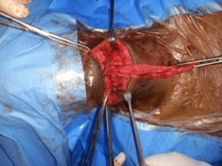 This clinical photograph shows an intraoperative view of an anterior neck dissection for a Sistrunk operation. The surgical field is prepared with blue drapes and a clear adhesive plastic incise drape. A transverse cervical incision has been made to expose the midline structures. The primary focus is the surgical manipulation of a ruptured thyroglossal duct cyst in a 72-year-old male patient. Visible instruments include tissue forceps and metal retractors (likely Langenbeck or similar) being used to maintain exposure of the subcutaneous layers and deeper strap muscles. Centrally, a reddish, fibrous, and irregular mass of tissue represents the ruptured cystic remnants and associated thyroglossal duct tract. The surgical site demonstrates signs of moderate tissue disruption and inflammation consistent with a long-standing cyst. The image illustrates the complex anatomy of the midline neck and the surgical approach required for the complete excision of thyroglossal duct remnants, including the necessary proximity to the hyoid bone.