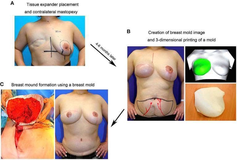 This composite of clinical photographs and 3D renderings illustrates a multi-stage approach to autologous breast reconstruction following mastectomy. Panel A shows a patient post-initial surgery with a tissue expander (TE) in the right breast and preoperative markings for a mastopexy on the contralateral left breast to address ptosis and symmetry. Panel B, captured 4-6 months later, displays the expanded right breast and a stabilized left mastopexy; it includes a 3D digital reconstruction and a physical 3D-printed breast mold created by mirroring the contralateral breast's shape. Markings on the lower abdomen indicate the donor site for a Deep Inferior Epigastric Perforator (DIEP) flap. Panel C documents the intraoperative phase where the 3D-printed mold is used to shape the DIEP flap tissue, followed by the final postoperative clinical result showing restored bilateral breast symmetry, volume, and contour. The workflow highlights the integration of 3D printing technology in precision plastic and reconstructive surgery to achieve optimal aesthetic outcomes in breast cancer patients.