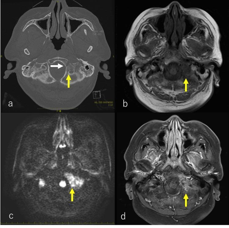 This composite of four axial images (a-d) demonstrates osteolytic bone metastasis at the skull base, a common site for secondary malignancies such as prostate cancer. Image (a) is a non-contrast CT in a bone window showing an osteolytic lesion (yellow arrow) extending from the left clivus (oblique plateau) to the occipital bone, with evidence of cortical destruction near the hypoglossal canal (sublingual neural tube, white arrow). Image (b) is a T1-weighted MRI where the corresponding lesion appears hypointense (yellow arrow) relative to normal bone marrow. Image (c) is a Diffusion-Weighted Image (DWI) showing marked hyperintensity (yellow arrow), suggesting restricted diffusion and high cellularity typical of metastatic tumors. Image (d) is a post-gadolinium contrast-enhanced T1-weighted MRI (or enhanced CT) showing abnormal enhancement in the lesion area (yellow arrow). These imaging modalities collectively define the extent of bone marrow replacement and surrounding tissue invasion, which in this clinical context caused cranial nerve deficits including hypoglossal nerve (CN XII) and vagus nerve (CN X) involvement.