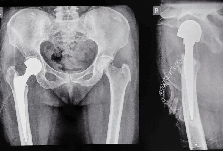 This diagnostic imaging set consists of postoperative anteroposterior (AP) and lateral X-ray views of the pelvis and right hip, demonstrating a right-sided cemented bipolar hemiarthroplasty. The prosthesis includes a metallic femoral stem securely positioned within the intramedullary canal of the proximal femur, a modular neck, and a large spherical bipolar femoral head articulating with the native acetabulum. A radio-opaque cement mantle is visible surrounding the femoral stem, ensuring fixation, and a small radio-opaque cement restrictor is identified distal to the stem tip on the lateral view. Surgical skin staples are visible along the lateral soft tissues. The contralateral left hip joint remains intact with no evidence of arthropathy. The pelvic ring, including the ilium, ischium, and pubis, shows normal alignment. This image serves as a teaching example for orthopedic oncology management, specifically the surgical reconstruction of a pathological femoral neck fracture secondary to metastatic disease using bone cement for both fixation and local tumor control.
