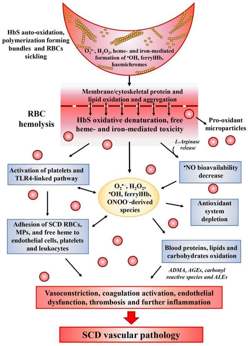 A medical pathophysiology diagram illustrating the oxidative stress cascade in Sickle Cell Disease (SCD) and its progression to vascular pathology. The diagram follows a vertical flow starting with a sickled red blood cell (RBC) undergoing HbS auto-oxidation and polymerization, leading to the generation of reactive oxygen species (ROS) such as H2O2, ferrylHb, and hemichromes. This triggers a central event of RBC hemolysis, characterized by membrane lipid oxidation, protein aggregation, and the release of pro-oxidant microparticles and L-arginase. Downstream pathways depict the systemic consequences, including the activation of platelets and the TLR4-linked inflammatory pathway, adhesion of SCD RBCs to endothelial cells and leukocytes, and a significant decrease in nitric oxide (NO) bioavailability. The lower section highlights the depletion of the antioxidant system and the oxidative modification of blood components into ADMA, AGEs, and ALEs. The cascade culminates in clinical manifestations such as vasoconstriction, endothelial dysfunction, and thrombosis, collectively summarized as SCD vascular pathology. This illustration is designed for advanced medical education regarding the molecular mechanisms of hematologic disorders.