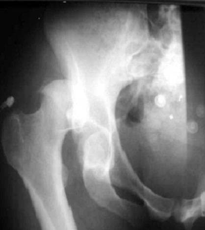 Anterior-posterior (AP) radiograph of the hip demonstrating a posterior hip dislocation and an associated acetabular fracture. The spherical femoral head is displaced superiorly and laterally relative to the acetabulum, indicating loss of articular congruity. A distinct, large bony fragment is visible adjacent to the posterior rim of the acetabulum, characteristic of a posterior wall fracture. This orthopedic emergency showcases a classic fracture-dislocation pattern, where the integrity of the posterior acetabular wall is compromised as the femoral head is forced out of the socket. The image is a critical educational example of pelvic trauma imaging, emphasizing the need for anatomical reduction and assessment of joint stability.