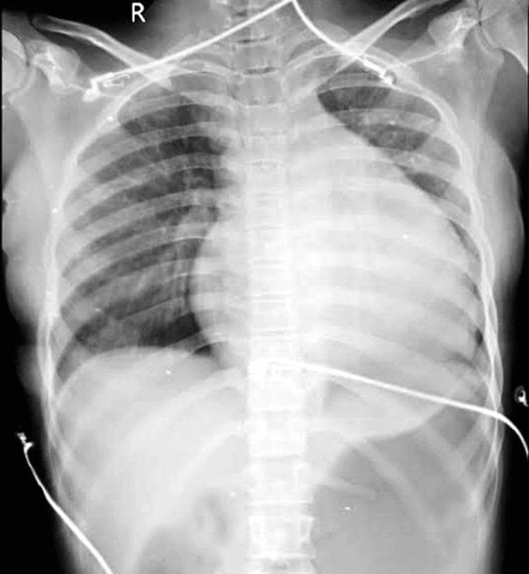 A frontal (anteroposterior) chest X-ray demonstrating a significantly enlarged cardiac silhouette, characteristic of severe cardiomegaly. The heart displays a globular or 'water-bottle' configuration, often associated with a large pericardial effusion. The cardiothoracic ratio is markedly increased, with the silhouette extending significantly toward the left thoracic wall. Pulmonary vascular markings appear somewhat obscured by the enlarged heart, although the lung fields are visible. Several radiopaque medical devices are present, including ECG leads and tubing overlying the chest and abdomen. An 'R' marker is visible in the upper right field. This image is clinically relevant for demonstrating the radiographic presentation of cardiomegaly and assessing for underlying conditions such as heart failure or pericardial tamponade.