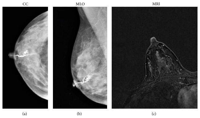 This composite diagnostic image showcases breast imaging findings in a 41-year-old patient with bloody nipple discharge, diagnosed histologically with papillomatosis. Panels (a) and (b) are galactographic (ductographic) images in craniocaudal (CC) and mediolateral oblique (MLO) projections, respectively. They demonstrate marked ductal ectasia (dilation) characterized by focal wall irregularities and intraductal filling defects within the contrast-enhanced mammary ducts. Panel (c) is an axial T1-weighted 3D FLASH MRI with contrast, showing prominent ductal enhancement and small hyperintense foci corresponding to the pathologic ductal changes. The image serves as an educational comparison between conventional galactography and contrast-enhanced MRI in the evaluation of pathological nipple discharge and intraductal lesions like papillomatosis. Key concepts illustrated include ductal morphology, contrast filling patterns, and the correlation between different imaging modalities in senology.
