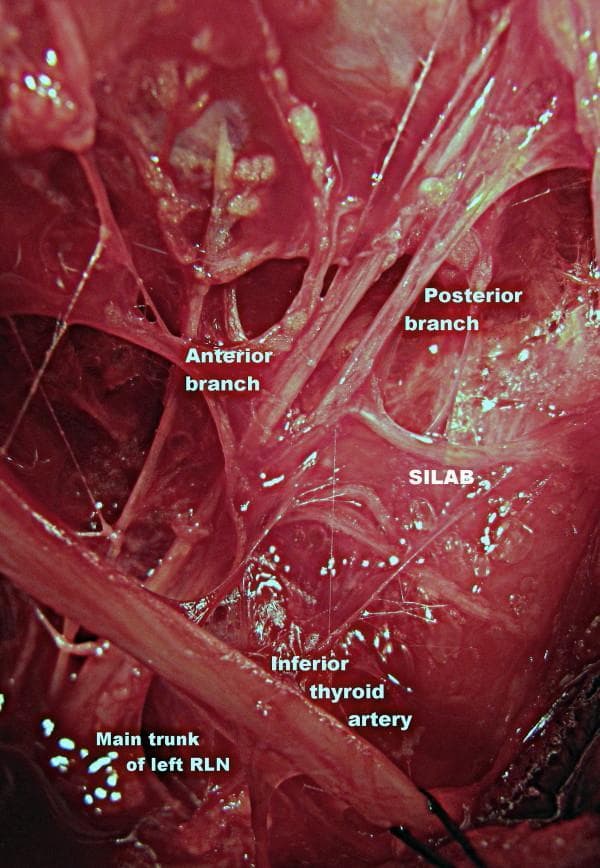 This magnified clinical operative photograph demonstrates the surgical anatomy of the left central neck compartment during thyroid surgery. The image highlights the variations in the course of the left recurrent laryngeal nerve (RLN) and its neurovascular relationships. The main trunk of the left RLN is visible in the lower quadrant, ascending and bifurcating into distinct anterior and posterior terminal branches. Medial to these branches, the inferior thyroid artery is identified, crossing the nerve path. A significant anatomical variation shown is the SILAB (Supra-Arterial Inferior Laryngeal Anastomotic Branch), a horizontal nerve anastomosis connecting the posterior branch of the RLN to adjacent neural structures near the laryngeal entry point. This photograph serves as an educational resource for identifying vulnerable neural structures during thyroidectomy and parathyroidectomy, emphasizing the clinical importance of meticulous dissection at the neurovascular crossing point to avoid iatrogenic nerve injury.