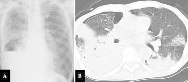This composite figure includes a frontal chest X-ray (Image A) and an axial thoracic CT scan (Image B) illustrating severe pulmonary complications. Image A shows extensive dense consolidation in the right upper and middle lobes, consistent with lobar pneumonia. A horizontal fluid level or dense opacity in the right lower zone indicates pleural effusion or atelectasis, while a peripherally lucent area suggests a concurrent pneumothorax. The left lung exhibits milder, patchy infiltrates. Image B provides a detailed cross-sectional view, revealing a significant right-sided pneumothorax with subsequent compression of the lung parenchyma. Bilateral abnormalities are evident, including dense consolidation and atelectasis in the dependent regions of both lungs, along with diffuse ground-glass opacities. These findings are clinically relevant to cases of gastrobronchial fistula, where gastric juice reflux induces severe necrotizing pneumonia and secondary spontaneous pneumothorax. The imaging highlights the severity of pulmonary involvement in patients with complex post-surgical or fistulous complications.