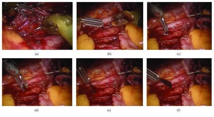 Six sequential intraoperative clinical photographs (a–f) documenting a robot-assisted laparoscopic retrieval of a broken scalpel blade. The images show a deep dissection of the retroperitoneal space, with key anatomical landmarks including the abdominal aorta and the bifurcation near the left common iliac artery. Robotic surgical instruments, including bipolar Cadier forceps and monopolar scissors, are used to carefully manipulate the retroperitoneal tissue. The sequence illustrates the localization of the foreign body (a–c), followed by the careful grasping and extraction of the sharp blade fragment (d–f) away from critical vascular structures. The surgical field displays a combination of retroperitoneal fat, vascular adventitia, and loop of bowel retracted to maintain exposure. This series highlights the management of intraoperative complications (retained foreign body) and the utility of robotic platforms for delicate dissection in close proximity to major vessels.