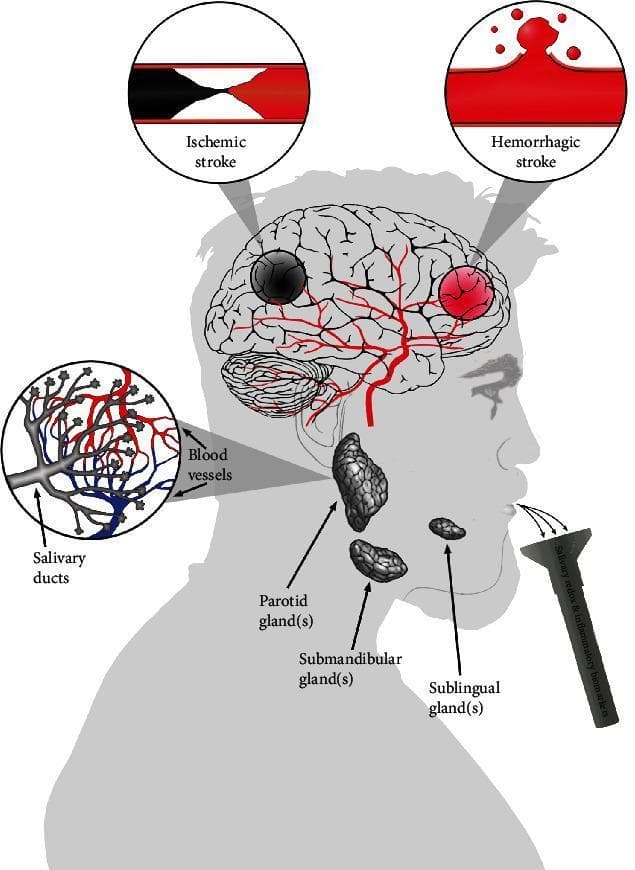 A medical infographic illustrating the physiological connection between cerebrovascular stroke and salivary biomarkers. The central image features a profile of a human head containing a brain with detailed vasculature. Two circular call-outs at the top contrast stroke types: 'Ischemic stroke' is shown as an arterial occlusion (blockage), while 'Hemorrhagic stroke' depicts a vessel rupture with extravasation of blood. Below, the three major salivary glands—parotid, submandibular, and sublingual—are labeled and shown in gray textured relief. An additional circular inset highlights the intricate interface between branching blood vessels and salivary ducts, emphasizing the mechanism of plasma filtration into saliva. A collection funnel at the mouth represents the non-invasive sampling of salivary redox and inflammatory biomarkers. The diagram serves an educational purpose for neurology and clinical chemistry, demonstrating how systemic markers of oxidative stress from brain injury can be detected in salivary secretions for diagnostic monitoring.