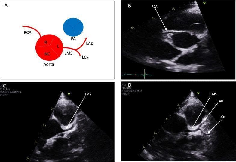 This composite educational graphic details normal human coronary artery anatomy through a schematic diagram and transthoracic echocardiography (TTE) images. Panel A presents a schematic illustrating the aorta with its three sinuses: Right (R), Left (L), and Non-Coronary (NC). It shows the Right Coronary Artery (RCA) originating from the right sinus and the Left Main Stem (LMS) originating from the left sinus, subsequently bifurcating into the Left Anterior Descending (LAD) and Left Circumflex (LCx) arteries. The Pulmonary Artery (PA) is shown in spatial relation to these structures. Panels B, C, and D are clinical diagnostic ultrasound images in the parasternal short-axis (PSAX) view at the level of the aortic valve. Panel B identifies the origin of the RCA. Panel C demonstrates the origin of the LMS from the aortic sinus. Panel D highlights the bifurcation of the LMS into the LAD and LCx. This material serves as a reference for identifying normal coronary ostia and branching patterns, essential for diagnosing anomalous coronary origins or interarterial courses.
