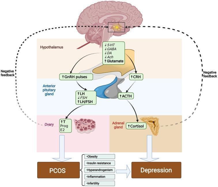 This pathophysiology diagram illustrates the neuroendocrine pathways linking the Hypothalamic-Pituitary-Gonadal (HPG) and Hypothalamic-Pituitary-Adrenal (HPA) axes in the context of Polycystic Ovary Syndrome (PCOS) and depression. The diagram shows a sagittal brain section highlighting the hypothalamus, where a decrease in inhibitory neurotransmitters (5-HT, GABA, DA, Ach) and an increase in glutamate lead to elevated GnRH pulses and CRH levels. This stimulates the anterior pituitary gland to increase LH secretion and the LH/FSH ratio, while simultaneously increasing ACTH. These hormonal shifts trigger the ovary to produce excessive testosterone (T) and estradiol (E2), and the adrenal gland to overproduce cortisol. The cascade culminates in clinical PCOS and depression, exacerbated by common pathological traits including obesity, insulin resistance, hyperandrogenism, inflammation, and infertility. Arrows indicate stimulatory pathways, while dashed lines represent disrupted negative feedback loops, providing a visual summary of hormonal dysregulation in gynecological and psychiatric co-morbidity.