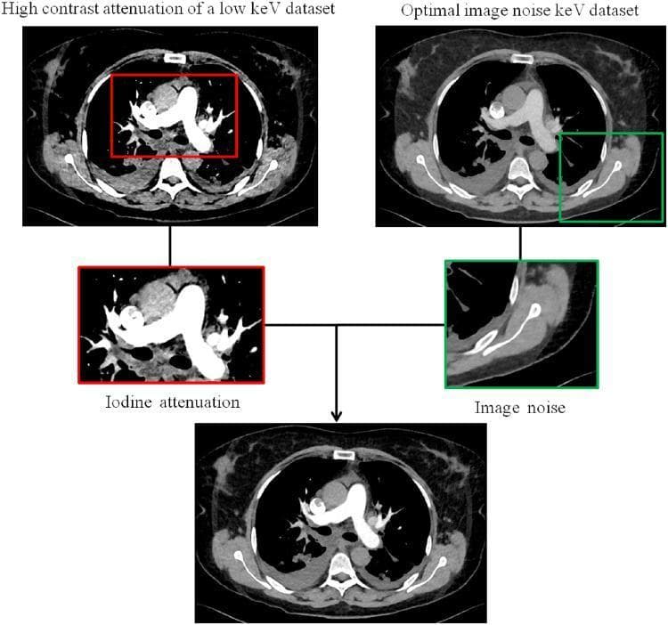 This diagnostic flowchart illustrates the monoenergetic reconstruction algorithm used in Dual-Energy Computed Tomography (DECT), specifically for CT Pulmonary Angiography (CTPA). The diagram displays three axial chest CT images and two magnified insets to demonstrate a frequency-split technique. The 'High contrast attenuation' image (typically at 40 keV) shows intense vascular enhancement of the pulmonary arteries but with significant image noise. The 'Optimal image noise' image (typically at 70 keV) shows smoother soft tissue texture but reduced vascular contrast. The algorithm decomposes these into sub-images: 'Iodine attenuation' (low spatial frequency stack) and 'Image noise' (high spatial frequency stack). These components are integrated into a final reconstructed image at the bottom, which achieves a clinical balance of high vascular iodine signal and minimized background noise. This educational visual explains the pathophysiological and radiological benefit of virtual monoenergetic spectral (VMS) imaging in optimizing contrast-to-noise ratio (CNR) for diagnosing conditions like pulmonary embolism.