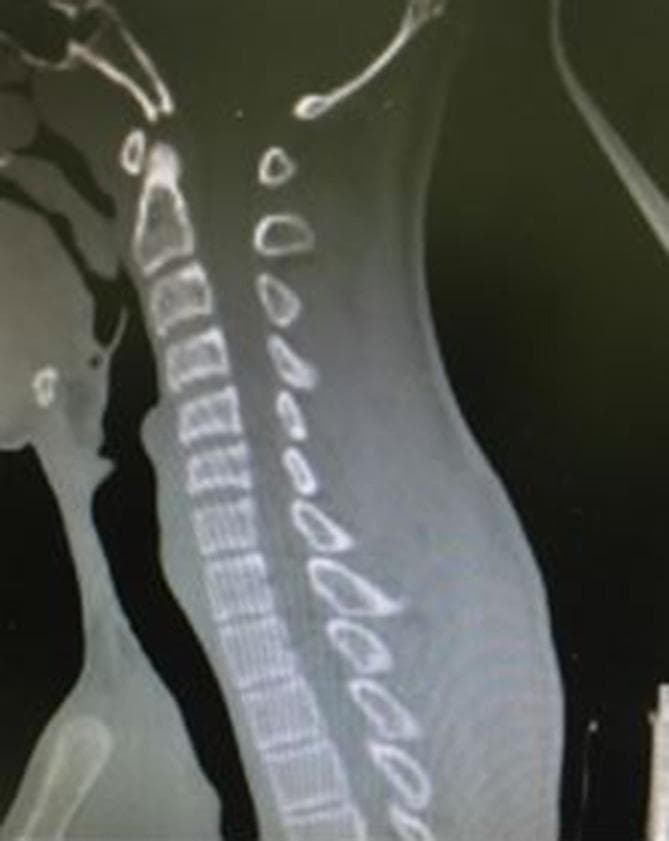This diagnostic image is a sagittal reformatted Computed Tomography (CT) scan of the cervical spine. The primary finding is a notable straightening of the cervical spine, representing a loss of the normal physiological cervical lordosis. The vertebral bodies and spinous processes appear intact, with no evidence of gross fracture, subluxation, or dislocation visible in this specific plane. The alignment of the vertebral bodies is linear rather than curved. In a clinical context, such straightening can be associated with acute muscle spasms, ligamentous injury, or post-traumatic guarding. This image serves as a baseline assessment for cervical spinal trauma and alignment, highlighting the importance of evaluating the curvature of the spine alongside bony integrity in radiological examinations.