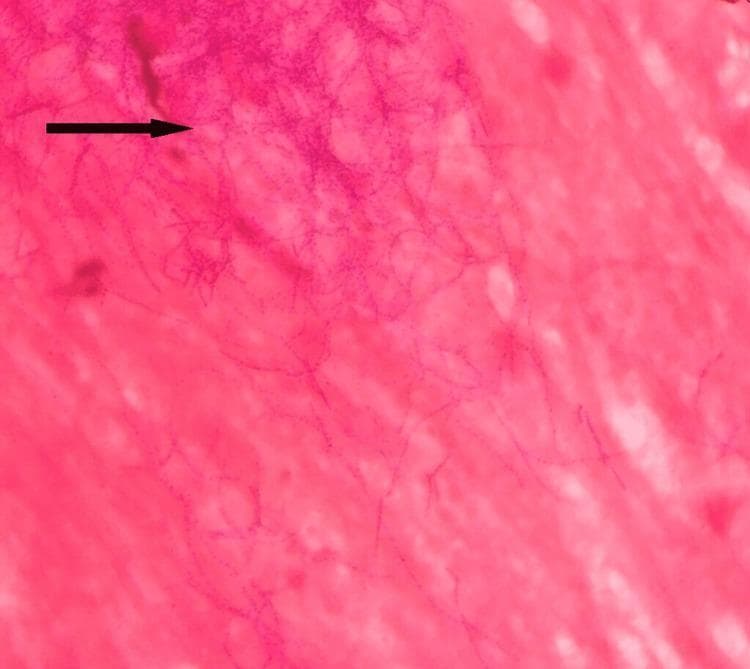 Diagnostic light microscopy image featuring a Gram stain of a clinical sputum sample at high magnification. The visual field demonstrates multiple Gram-positive (dark purple) microorganisms set against a pink-stained proteinaceous and cellular background. The pathogens exhibit a distinctive morphology characterized by long, slender, filamentous rods with frequent branching patterns. A characteristic 'beaded' appearance is evident along the length of the filaments, where the crystal violet stain appears irregularly distributed in alternating dark and light segments. These morphological features—Gram-positive staining, branching filaments, and beaded appearance—are classic diagnostic indicators for Nocardia species. This image serves as an educational resource for medical microbiology, illustrating the differentiation between typical pyogenic bacteria and branching actinomycetes in respiratory infections.