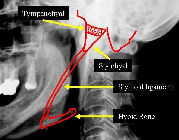 This lateral neck radiograph features a diagnostic overlay illustrating Eagle syndrome or stylohyoid ligament ossification. A red outline traces the pathological ossification of the stylohyoid chain, extending from the skull base to the hyoid bone. Key anatomical landmarks are labeled with yellow arrows: the Tympanohyal region (superiorly near the temporal bone), the Stylohyal (the proximal portion of the styloid process), the elongated and ossified Stylohyoid ligament, and its distal attachment at the Hyoid Bone. The image demonstrates the relationship of this ossified structure to adjacent anatomy, including the posterior border of the mandible and the cervical spine. The visual focus is the continuous, elongated bony projection that can cause clinical symptoms such as dysphagia or facial pain. This material is suitable for dental, ENT, and radiology students studying craniofacial anatomy and calcification disorders of the head and neck.