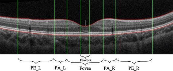 This diagnostic image is an Optical Coherence Tomography (OCT) cross-section of a human retina, specifically illustrating the anatomical subdivisions of the macula. The image features a normal retinal profile with a characteristic central thinning at the foveal depression. Two red horizontal lines delineate the upper boundary, the Inner Limiting Membrane (ILM), and the lower boundary, the Retinal Pigment Epithelium (RPE). Green vertical lines subdivide the macular region into clinical zones: the central foveola (marked with a white indicator at its center), the fovea, the flanking parafovea (PA_L and PA_R), and the outer perifovea (PE_L and PE_R). The visualization demonstrates the relative thickness variations across these regions, where the inner retinal layers are displaced laterally at the fovea to allow light to reach the photoreceptors directly. This schematic is primarily used in ophthalmology to establish a reference model for identifying morphological abnormalities, such as drusen, epiretinal membranes, or macular edema, by quantifying layer thickness and curvature within specific macular zones.
