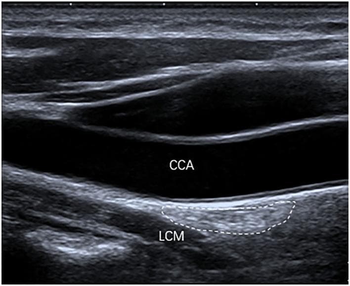 This longitudinal diagnostic ultrasound image illustrates the anatomy of the cervical sympathetic chain, specifically focusing on the stellate ganglion (SG). The stellate ganglion is highlighted by a dashed white outline, demonstrating a characteristic oval shape. Visually, the ganglion exhibits marked hyperechogenicity relative to the adjacent musculature. Anatomical landmarks are labeled for spatial orientation: the Common Carotid Artery (CCA) appears as an anechoic (black) lumen situated anterior to the ganglion, while the Longus Colli Muscle (LCM) is positioned immediately posterior to the ganglion. The image serves as an educational reference for identifying sympathetic nervous system structures in the neck, emphasizing the relationship between vascular and muscular planes in regional anesthesia or pain management procedures. The hyperechoic appearance and ill-defined margins are key sonographic features for identifying the SG within the prevertebral fascia.