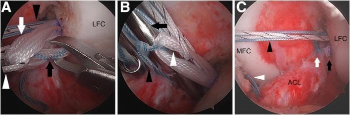 This three-panel diagnostic clinical photograph set demonstrates the arthroscopic technique for linking an anterior cruciate ligament (ACL) grasping suture to an adjustable femoral loop during a Bridge-Enhanced ACL Repair (BEAR) procedure in a left knee. Panel A illustrates the initial configuration where one limb of the blue/white ACL-grasping suture is passed through the white adjustable loop. Key landmarks include the lateral femoral condyle (LFC), internal brace sutures, and the TigerWire countertraction suture. Panel B shows the use of a metal switching stick inserted through the far anteromedial portal to maintain spacing while the ACL-grasping suture is tied to the adjustable loop, ensuring smooth loop sliding. Panel C displays the completed sequence where the adjustable loop has been shortened to eliminate slack in the grasping suture, bringing the ACL stump into proximity with the femoral notch. The medial femoral condyle (MFC) and a tibial shuttling suture are visible in this final panel, representing successful linkage and tensioning of the repair construct.