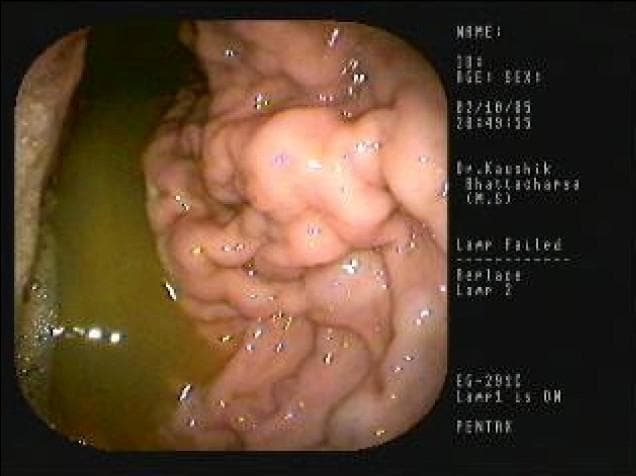 This clinical photograph displays a human upper gastrointestinal endoscopy focused on the gastric body. The image demonstrates a classic presentation of Menetrier's disease, a rare hypertrophic gastropathy. The primary visual finding is the presence of massively enlarged, thickened gastric rugae that exhibit a convoluted, cerebriform, or 'cobblestone' appearance. These hypertrophic folds appear congested and edematous, significantly obstructing the gastric lumen compared to normal mucosal architecture. A pool of greenish-yellow bile-stained fluid is visible in the dependent portion of the stomach (lower-left), suggesting an altered gastric environment or reflux. This imaging modality is essential for identifying the characteristic mucosal hyperplasia and protein-losing gastropathy associated with the condition. The educational focus is on the endoscopic identification of giant rugal folds and the differential diagnosis of hypertrophic gastropathies, including Zollinger-Ellison syndrome and infiltrative malignancies.