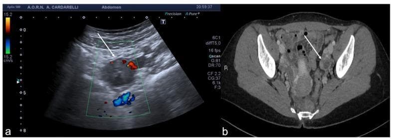 This dual-panel image demonstrates a tubo-ovarian complex involving a left adnexal abscess, illustrated through two diagnostic imaging modalities.
Panel (a) is an axial color Doppler transabdominal ultrasound (TSA-US) scan. It reveals a complex cystic mass in the left adnexa characterized by a predominantly anechoic central region, consistent with fluid or purulent material. The color Doppler overlay shows peripheral vascularization (arrow) indicated by red and blue signals around the margins of the mass, reflecting active blood flow in the surrounding inflammatory tissue.
Panel (b) is a contrast-enhanced axial CT image of the pelvis. It shows a corresponding left adnexal abscess with a distinctively thickened and hyper-enhancing wall (arrows). The enhancement indicates increased vascularity and inflammation characteristic of an infectious process.
These findings are critical for diagnosing pelvic inflammatory disease (PID) and its complications, such as tubo-ovarian abscesses (TOA). This comparison illustrates how ultrasound serves as a primary tool for evaluating vascular compromise and cystic morphology, while CT provides superior detail regarding wall thickening and regional inflammatory extent.