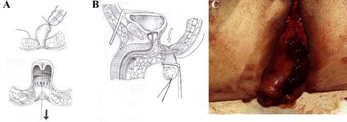 This composite educational image illustrates a surgical technique for rectal cancer resection, specifically focusing on the eversion and stapling of the rectal stump. Panel A provides a schematic diagram showing the eversion of the rectum through the anal canal, with a tumor located on the mucosal surface. Panel B presents a sagittal cross-section anatomical illustration of the male pelvis, depicting the distal rectum pulled through the perineum. A linear stapler is shown positioned to provide a safe distal clearance margin from the tumor, while preserving pelvic structures like the bladder and prostate. Panel C is an intraoperative clinical photograph demonstrating the real-world application of the technique. It shows a dark red, fleshy, and irregular tissue mass—the everted rectal stump containing the tumor—protruding from the perianal region. The image series demonstrates key steps in a modified pull-through procedure aimed at achieving an oncologically safe margin before performing a low colorectal or coloanal anastomosis. This material is designed for surgical education in colorectal oncology and gastrointestinal surgery.