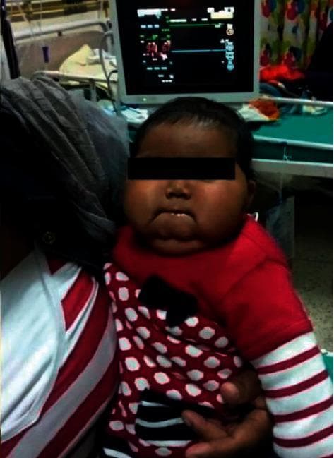 This clinical photograph displays a 15-month-old child exhibiting 'moon facies,' a classic sign of hypercortisolism (Cushing syndrome). The face is notably rounded and plethoric with a circular contour. There is significant soft tissue fullness in the bilateral malar regions (prominent cheeks) and noticeable submental fat accumulation beneath the chin. The child has a medium-to-dark complexion. The image is set in a clinical environment, with a patient monitor displaying vital signs visible in the background. This visual finding is characteristic of exogenous steroid exposure, either through the mother's milk (secondary to maternal prednisolone use) or direct topical application of potent corticosteroids like clobetasol. The photograph serves as an educational example of pediatric iatrogenic Cushing syndrome and its associated physical manifestations.
