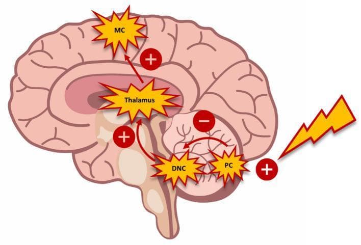 This pathophysiology diagram illustrates the cerebello-thalamo-cortical circuit and the mechanism of cerebellar brain inhibition (CBI) within a sagittal view of the human brain. The schematic highlights the functional connectivity between the Purkinje cells (PC) of the cerebellar cortex, the deep cerebellar nuclei (DCN), the thalamus (specifically the ventrolateral nucleus), and the motor cortex (MC). An external stimulus, representing transcranial magnetic stimulation (TMS), is depicted as a lightning bolt triggering an excitatory (+) effect on the Purkinje cells. This activation leads to an inhibitory (-) connection from the PC to the DCN. Subsequent excitatory (+) pathways are shown ascending from the DCN to the thalamus, and from the thalamus to the motor cortex. The diagram demonstrates how cerebellar activation can modulate motor cortex excitability through this multi-synaptic pathway. Key labels include MC (Motor Cortex), Thalamus, DCN (Deep Cerebellar Nuclei), and PC (Purkinje Cells), with red arrows indicating the flow of neural signals and +/- signs denoting the nature of the synaptic influence.