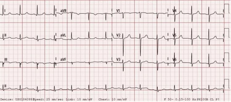 A standard 12-lead electrocardiogram (ECG) displayed on a red grid background, demonstrating normal sinus rhythm at a rate of approximately 70 beats per minute. The tracing includes limb leads (I, II, III), augmented limb leads (aVR, aVL, aVF), precordial leads (V1-V6), and a continuous rhythm strip of lead II at the bottom. The QRS complexes exhibit normal duration and morphology without pathological widening. P waves are identifiable before each QRS complex, indicating atrial depolarization originating from the sinoatrial node. T waves are upright in leads I, II, aVF, and V2-V6, and appropriately inverted in lead aVR. There is a lack of acute ST-segment elevation or depression. The R-R intervals are regular, reflecting a stable cardiac rhythm. This tracing represents the resolution of previously identified junctional bradycardia following the treatment of hyperkalemia. The technical parameters are visible at the bottom, indicating a standard paper speed of 25 mm/sec and voltage calibration of 10 mm/mV.