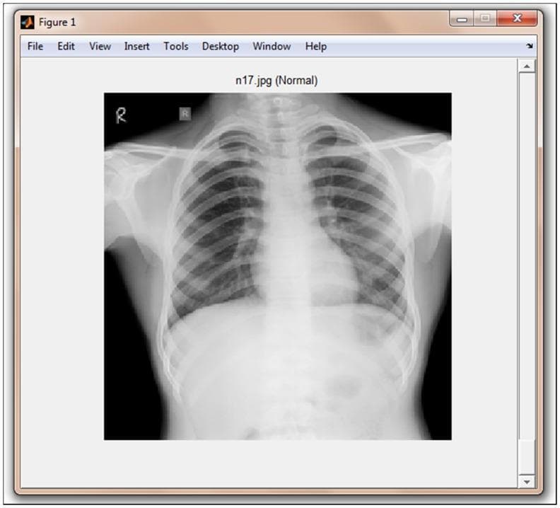 This diagnostic image shows a posteroanterior (PA) or anteroposterior (AP) chest X-ray (CXR) displayed within a MATLAB graphical user interface titled 'TB-Xpredict'. The radiograph depicts a normal adult thorax. Key anatomical structures include the radiopaque bony framework—specifically the clavicles, ribs, and vertebral column—and the radiolucent lung fields. The cardiac silhouette is visible within the central mediastinum, with clear costophrenic and cardiophrenic angles. The pulmonary vasculature exhibits normal branching patterns without evidence of consolidation, infiltrates, or pleural effusion. The image is labeled 'n17.jpg (Normal)', serving as a baseline reference for computer-aided detection (CAD) systems designed to screen for pulmonary tuberculosis (TB). This content is relevant for medical students and radiology residents focusing on normal thoracic anatomy and the application of machine learning algorithms (such as Gist or PHOG features) in automated diagnostic screening.