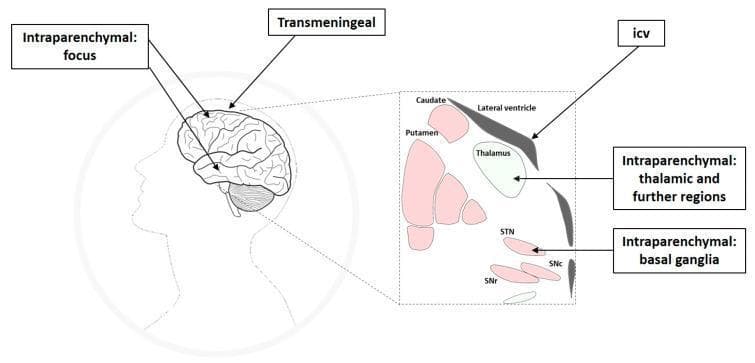 This medical illustration outlines intracranial drug delivery routes for pharmacological seizure control in treatment-resistant epilepsy. The diagram consists of a sagittal profile of a human head and an inset expanded view of subcortical structures. Four primary delivery pathways are identified: (1) Intraparenchymal targeting the cortical seizure focus directly; (2) Transmeningeal, where drugs diffuse through the meninges to reach neocortical areas; (3) Intracerebroventricular (icv), targeting regions adjacent to the lateral ventricle; and (4) Intraparenchymal targeting remote epileptic network structures. The expanded subcortical view highlights key anatomical targets for deep-brain delivery, including the thalamus, caudate, and putamen, as well as specific components of the basal ganglia: the subthalamic nucleus (STN), substantia nigra pars compacta (SNc), and substantia nigra pars reticulata (SNr). The illustration emphasizes the shift from systemic administration to network-specific targeting to modulate seizure propagation and initiation while minimizing functional loss in eloquent brain areas.