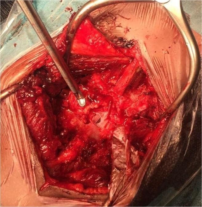 This clinical photograph captures an intraoperative view of a surgical field in the lower lumbar spine (L4-L5 level). A self-retaining retractor is used to maintain exposure of the paravertebral musculature, which shows signs of traumatic disruption and surgical dissection. Following a laminectomy and ligamentum flavum decompression, the central focus of the image is a clear dural laceration, appearing as a white, glistening membrane defect. A metallic surgical suction tip is positioned within the wound to maintain a clear field by removing blood and cerebrospinal fluid. The operative site demonstrates disrupted anatomical structures including the bone margins of the laminae and surrounding soft tissue. This image illustrates the surgical management of a traumatic spinal injury and the visualization of the underlying dura mater prior to primary repair. Key educational concepts include surgical anatomy of the lumbar spine, intraoperative identification of dural defects, and the application of neurosurgical decompression techniques.
