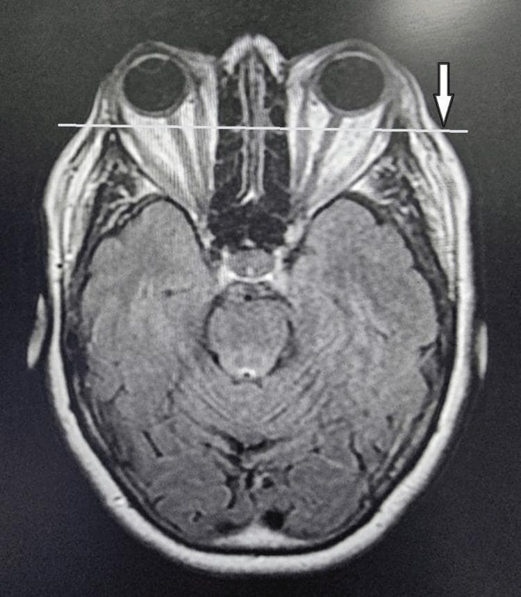 This diagnostic image is an axial view Magnetic Resonance Imaging (MRI) of the head, specifically focusing on the orbits and brain. The scan demonstrates significant bilateral proptosis (exophthalmos), characterized by the anterior displacement of the globes relative to the orbital rims. A horizontal white line and a white arrow on the left side highlight the degree to which the eyeballs protrude beyond the lateral orbital margin. Visible within the retrobulbar space is evidence of extraocular muscle enlargement and orbital fat hypertrophy, typical findings associated with Graves' ophthalmopathy (thyroid-associated orbitopathy). The optic nerves are visible and appear stretched due to the globe displacement. The brain section shows the midbrain, cerebral hemispheres with visible gyri and sulci, and the interhemispheric fissure. This image serves as an educational tool for identifying radiological signs of restrictive orbitopathy and secondary complications like proptosis.