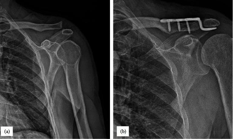This composite educational resource consists of two anteroposterior (AP) shoulder radiographs demonstrating the management of a high-grade acromioclavicular (AC) joint injury. Image (a) shows a preoperative view of a Rockwood Type III AC joint dislocation. Key findings include superior displacement of the distal clavicle relative to the acromion, indicating a complete rupture of the acromioclavicular and coracoclavicular ligaments. The coracoclavicular distance is significantly widened, while the glenohumeral joint remains aligned. Image (b) shows the same shoulder six months postoperatively following open reduction and internal fixation (ORIF). An orthopedic hook plate is visible, with the plate body secured to the superior distal clavicle by three cortical screws and the hook portion positioned beneath the acromion process. This hardware successfully maintains vertical stability and joint reduction, evidenced by the restored alignment of the inferior borders of the distal clavicle and acromion. These images illustrate the radiological diagnosis and surgical stabilization of traumatic AC joint instability using a hook plate construct.