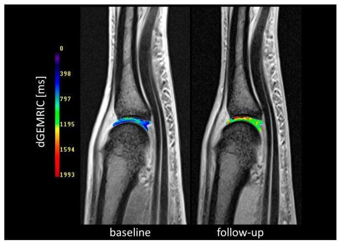 Comparison of delayed Gadolinium-Enhanced Magnetic Resonance Imaging (dGEMRIC) maps of the third metacarpophalangeal (MCP3) joint, illustrating cartilage composition changes in a patient with early rheumatoid arthritis. The image displays a side-by-side comparison of 'baseline' and 'follow-up' (24 weeks post-adalimumab plus methotrexate therapy) states, fused with morphological MRI scans. A color-coded scale on the left represents dGEMRIC values in milliseconds (ms), where blue/purple indicate low glycosaminoglycan (GAG) content (cartilage damage) and red/yellow indicate high GAG content (healthy cartilage). At baseline, the articular cartilage is predominantly blue, signifying significant GAG depletion. At follow-up, there is a visible spatial shift toward green and red hues centrally within the joint space, indicating increased dGEMRIC values and cartilage biochemical regeneration. This imaging modality demonstrates the utility of functional MRI in monitoring pharmacological response to biologic therapy beyond simple structural assessment.