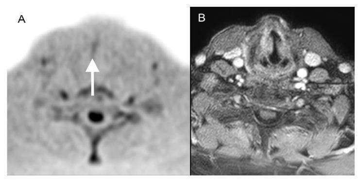 This diagnostic imaging comparison displays two axial MRI views of the larynx in an 80-year-old patient with squamous cell carcinoma of the right vocal cord (pT1a). Image A is a Diffusion-Weighted Whole-body Imaging with Background Body Signal Suppression (DWIBS) scan. It shows a focal area of high signal intensity (hyperintensity) on the right vocal cord, indicated by a white arrow, which represents restricted diffusion characteristic of malignant tissue. While the resolution in DWIBS is lower and anatomical boundaries are less distinct, the lesion is clearly identified. Image B is a contrast-enhanced transversal T1-weighted scan with fat saturation. This sequence provides superior anatomical resolution of laryngeal cartilages and surrounding soft tissues but fails to clearly distinguish the small T1a carcinoma from the normal vocal cord morphology or enhancement. The comparison illustrates the clinical utility of functional imaging (DWIBS) in detecting early-stage (pT1a) glottic cancer that may be occult on standard morphological MRI sequences.