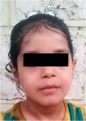 This clinical photograph shows the frontal view of a pediatric patient following treatment for niacin deficiency (pellagra). The image demonstrates a complete resolution of previously severe dermatological symptoms. The facial skin appears smooth and healthy, with an even tone and a total absence of the scaly, desquamating rash and hyperpigmentation characteristic of pellagra. The forehead and cheeks show no signs of inflammation or photosensitivity-induced lesions. The scalp and hairline appear normal with no evidence of alopecia or dermatitis. This visual serves as an educational comparison to show therapeutic success in managing Hartnup disease or secondary nutritional deficiencies through oral niacin supplementation. The patient's eyes are masked for privacy, while the remaining facial features highlight the restoration of normal skin integrity and texture in a clinical dermatology context.